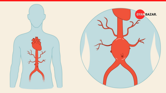 Aortic Aneurysm: Causes, Symptoms, and Warning Signs
