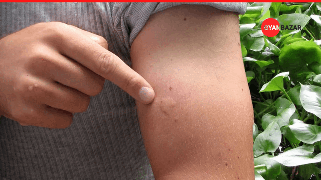What To Do When Bites And Stings Strike
