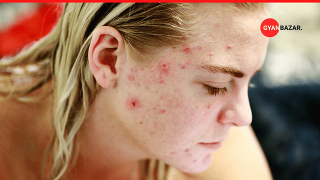 Acne – How To Identify, Treat and Prevent Acne Scars.